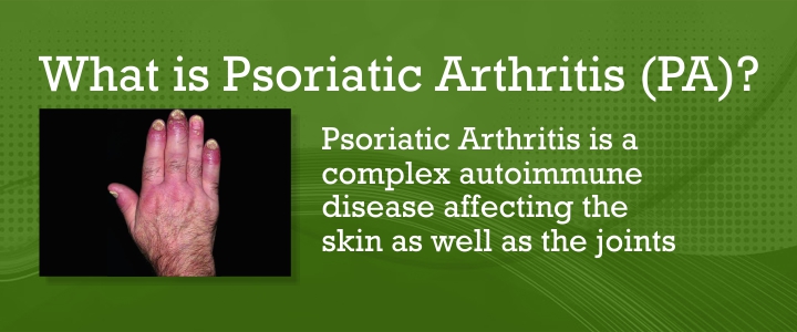 Psoriatic Arthritis